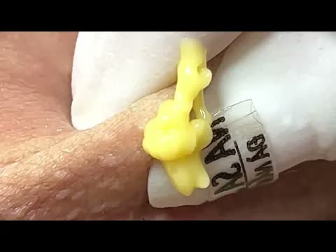 Relax Squeezing Out Blackheads #36 Черные точки
