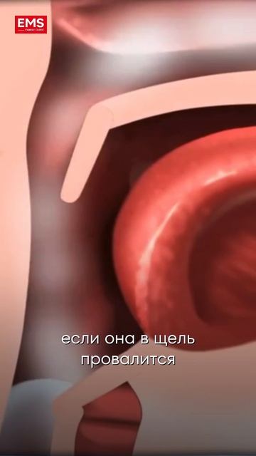Случай из практики | Роднякова Елена Борисовна врач-оториноларинголог клиники EMS
