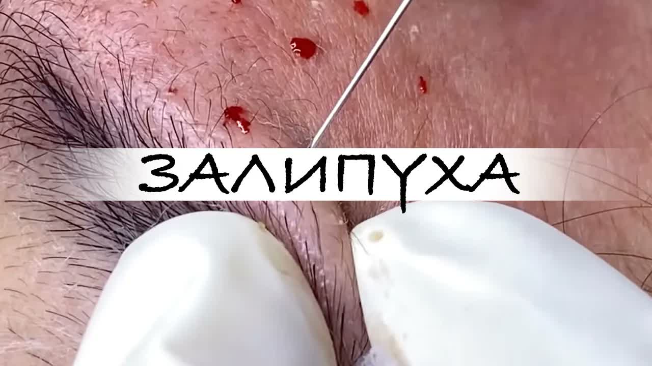ПРЫЩИ 😍 ПРЫЩИ ВЫДАВЛИВАНИЕ 😍 ПОДБОРКА ВЫДАВЛИВАНИЕ ПРЫЩЕЙ #прыщи #acne #asmr