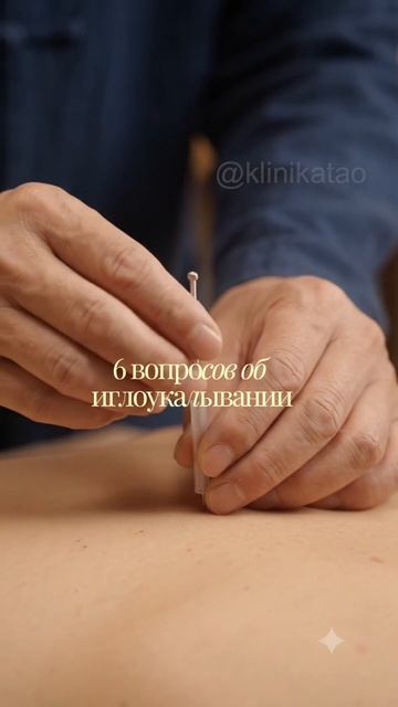 6 вопросов об иглоукалывании
