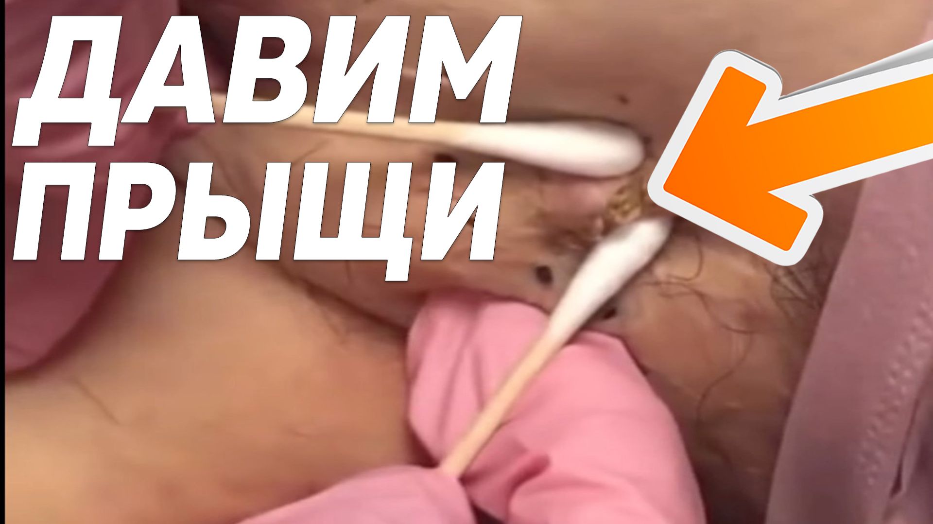 Релакс видео по выдавливанию черных точек и прыщей