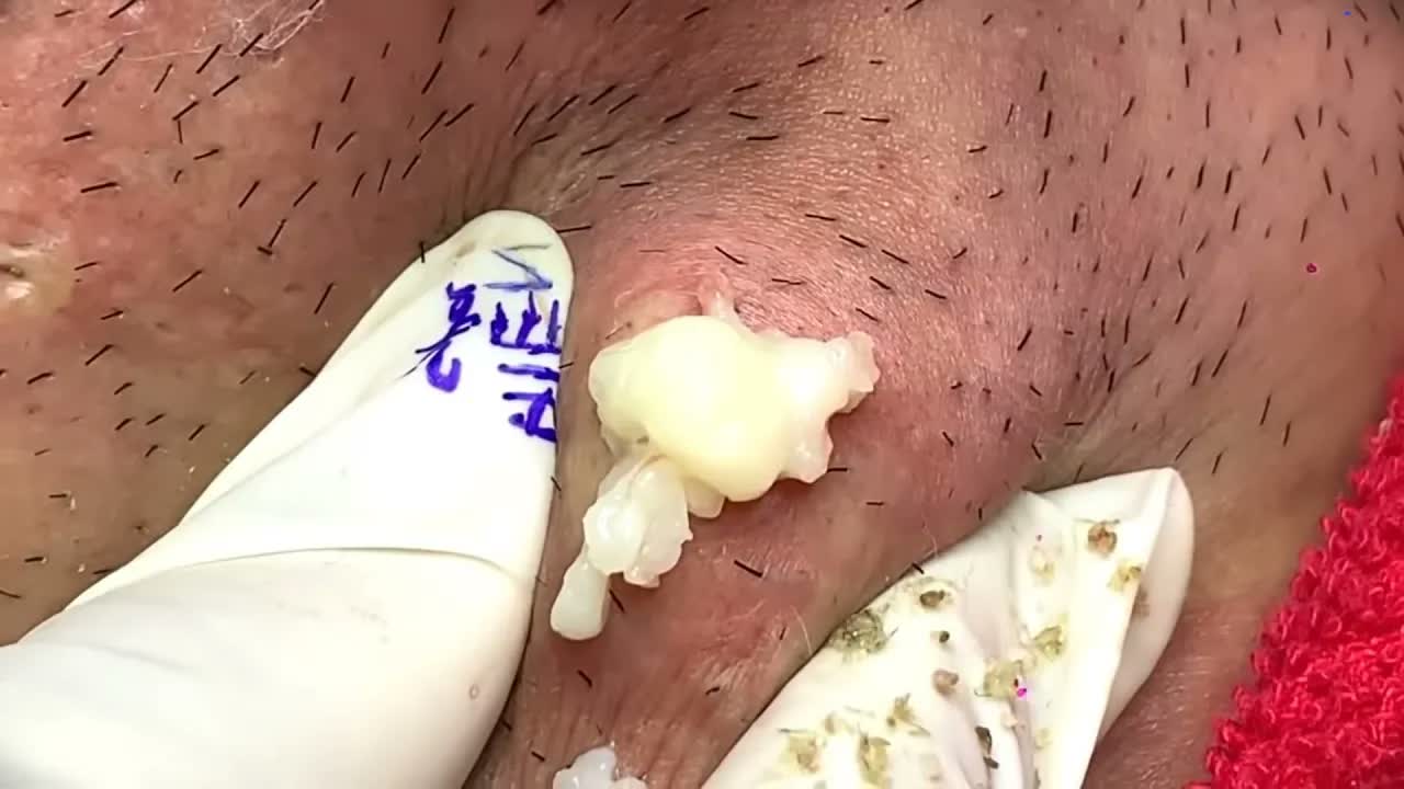 Relax Squeezing Out Blackheads #31 Черные точки