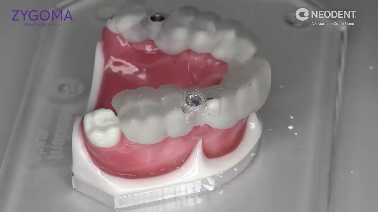 Протокол сверления Neodent Helix GM 3 75х11 5 кость III–IV — навигационный набор