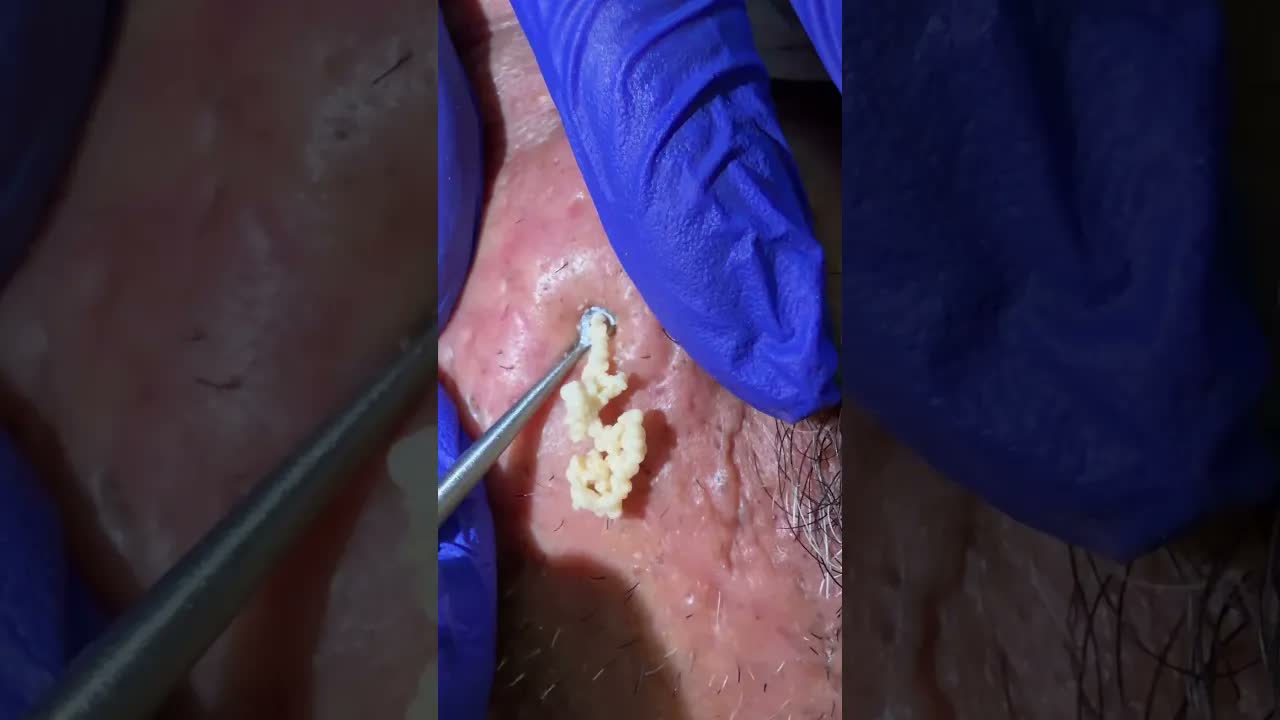 Удаление чёрных точек на носу #skincare #blackheads #shorts