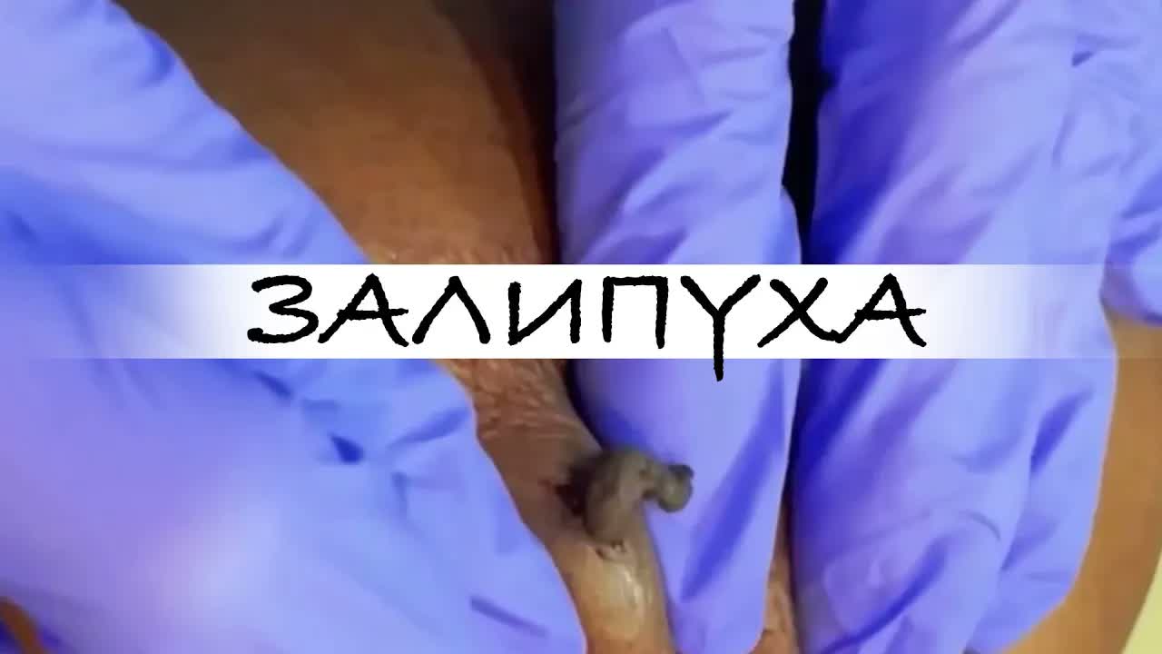 ПРЫЩИ 😍 ПРЫЩИ ВЫДАВЛИВАНИЕ 😍 ПОДБОРКА ВЫДАВЛИВАНИЕ ПРЫЩЕЙ #прыщи #acne #asmr #какубратьпрыщи
