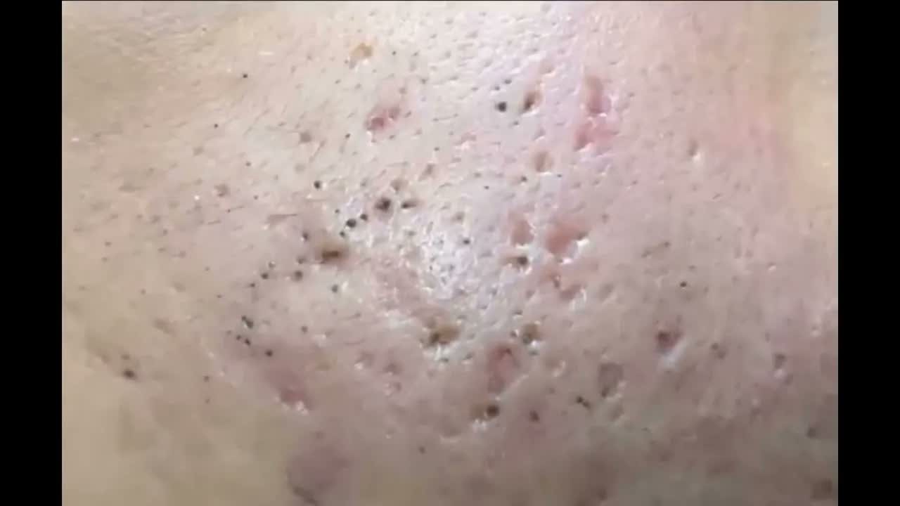 Relax Squeezing Out Blackheads #49 Черные точки