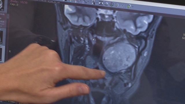 Нижегородские хирурги сделали уникальную операцию по удалению опухоли околоушной железы