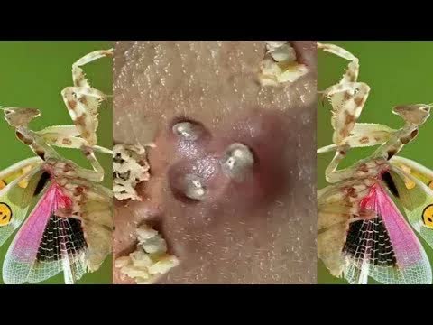 Relax Squeezing Out Blackheads #35 Черные точки