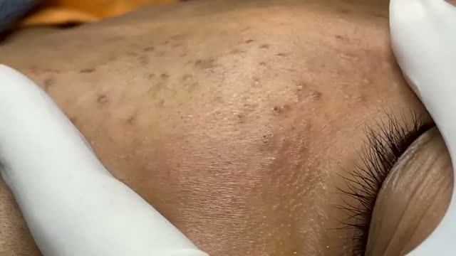 Удаление акне без воспалений: ход процедуры