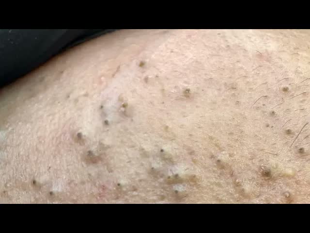 Глубокие поры под толстой ороговевшей кожей и мозоли | Профессиональный уход
