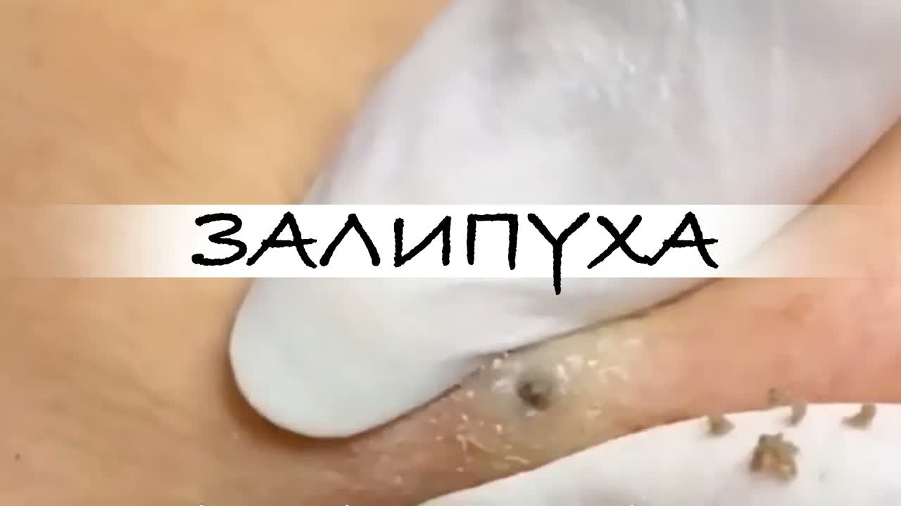 ПРЫЩИ ВЫДАВЛИВАНИЕ. ВЫДАВЛИВАНИЕ ПРЫЩЕЙ. ВЫДАВЛИВАНИЕ ЧЕРНЫХ ПРЫЩЕЙ НА ЛИЦЕ. #прыщи #acne #asmr