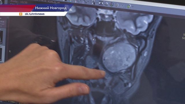 Нижегородские хирурги сделали уникальную операцию по удалению опухоли околоушной железы