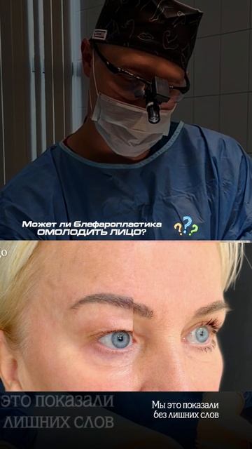 Верхняя блефаропластика, работа нашего пластического хирурга Симонова В.О.