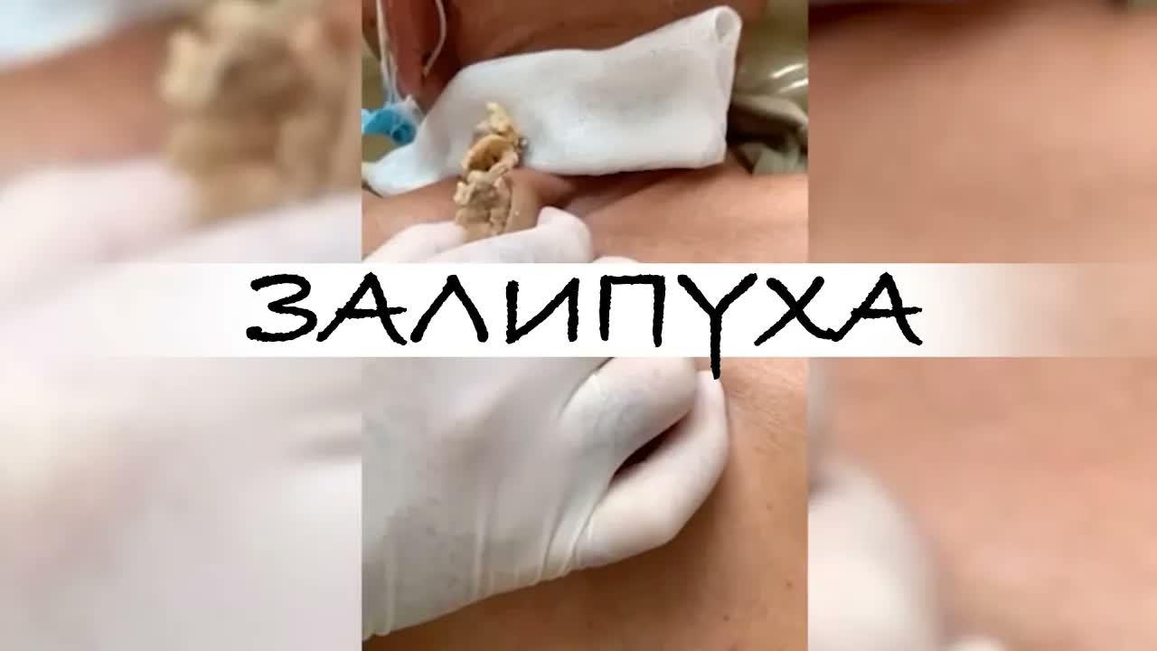 ПРЫЩИ. АТЕРОМА СПИНЫ. ДАВИМ ПРЫЩИ НА СПИНЕ. ПРЫЩИ ВЫДАВЛИВАНИЕ. ПРЫЩИ ЖЕСТЬ #acne #asmr #прыщи