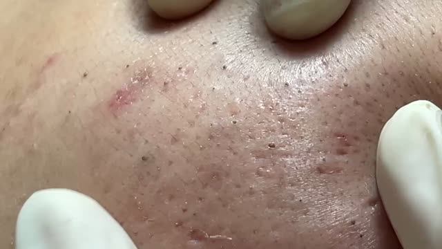 Удаление прыщей и акне с кожи лица