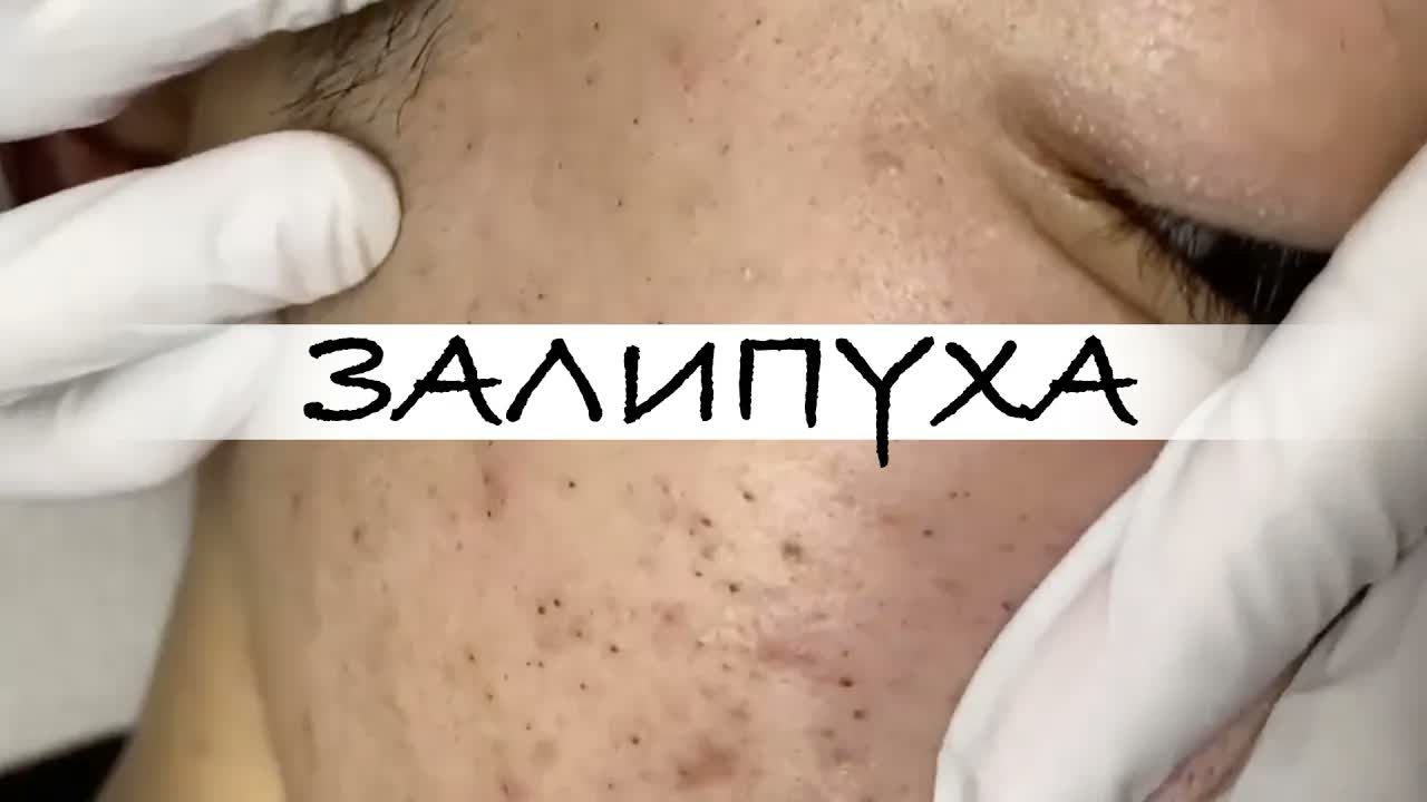 ПРЫЩИ 😍 ПРЫЩИ ВЫДАВЛИВАНИЕ 😍 ПОДБОРКА ВЫДАВЛИВАНИЕ ПРЫЩЕЙ #прыщи #acne #asmr #прыщиналице