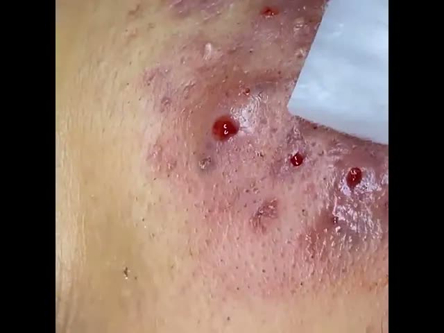 Relax squeezing out blackheads 6 Черные точки