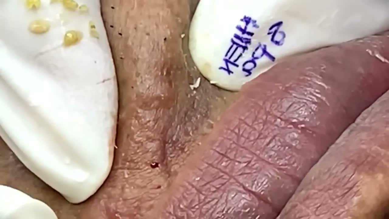 Relax squeezing out blackheads 30 Черные точки