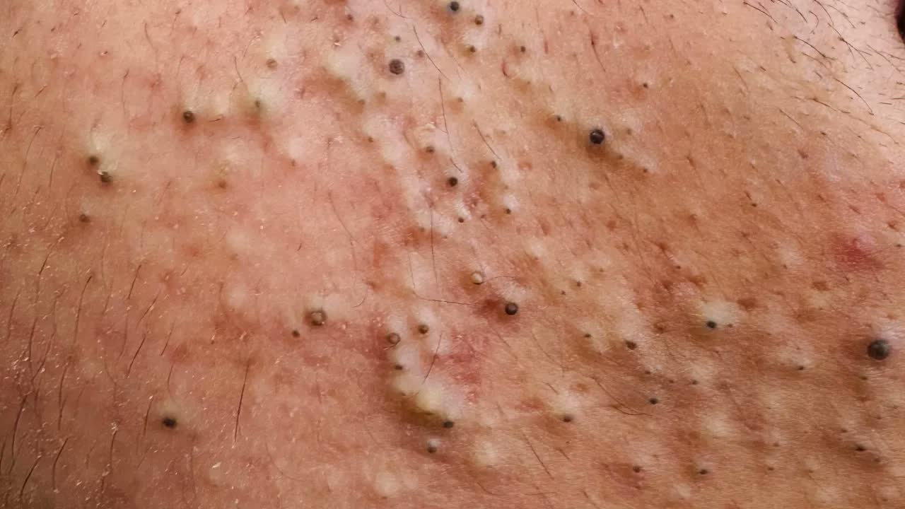 Удаление чёрных точек и прыщей