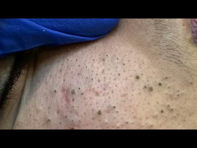 Как убрать чёрные точки с корейским уходом для гладкой и сияющей кожи