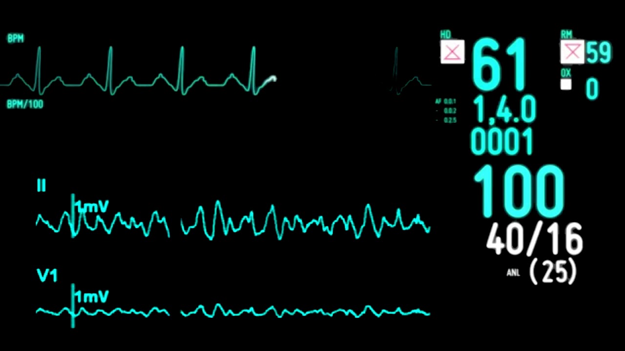 ECG Monitor Экг монитор футаж Пульс сердца