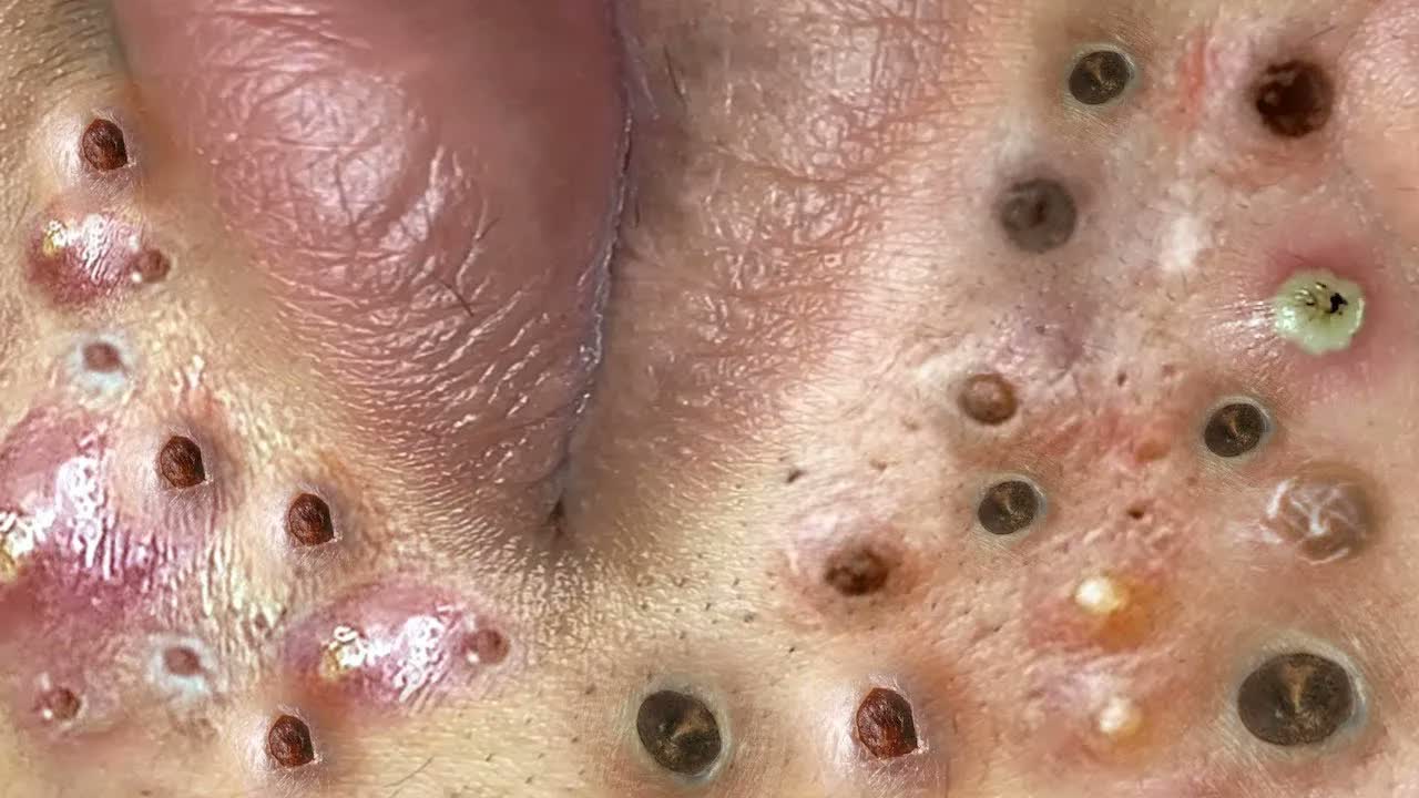 Relax squeezing out blackheads 46 Черные точки