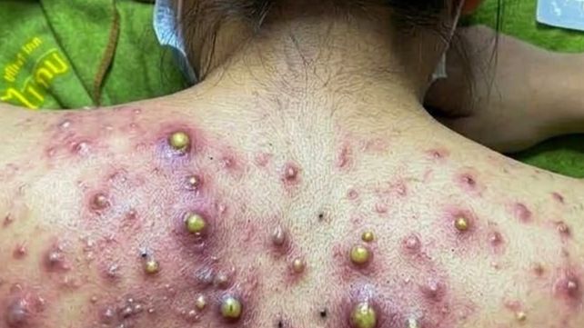 выдавливание прыщей угри акне