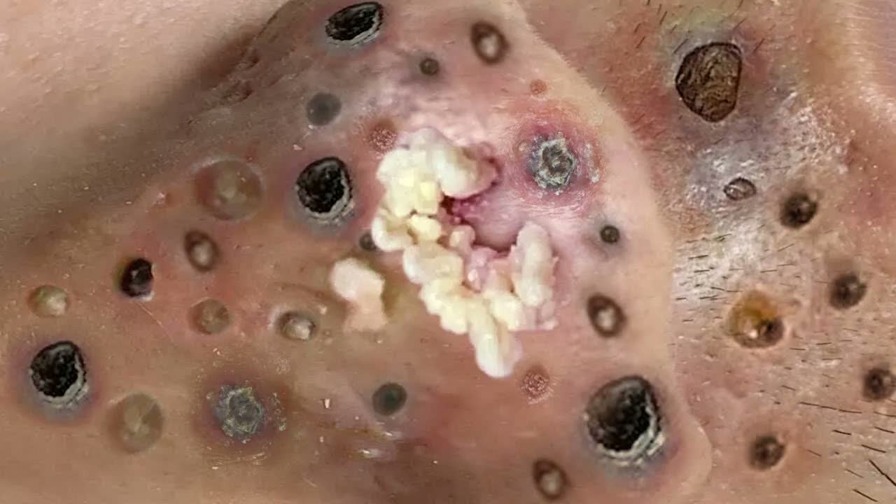 Relax squeezing out blackheads 48 Черные точки