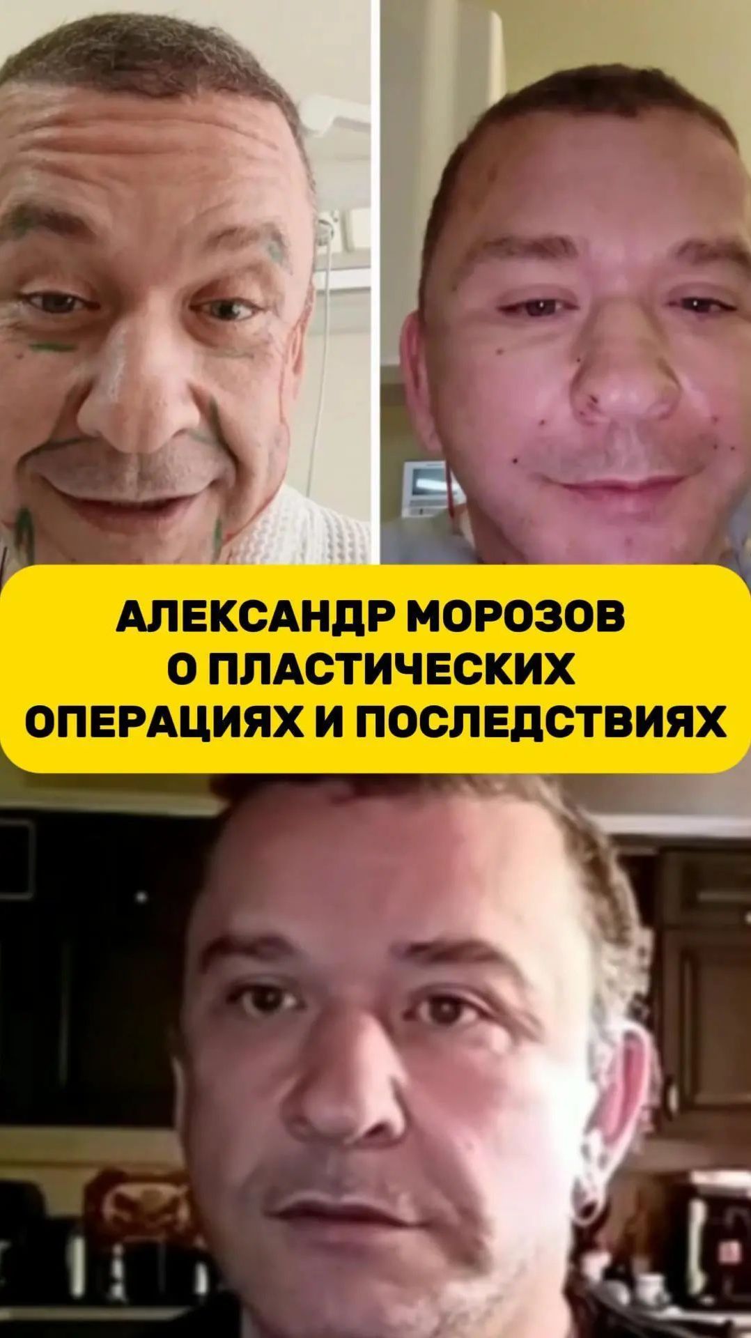 Александр Морозов о пластических операциях и последствиях // ИзолентаLive