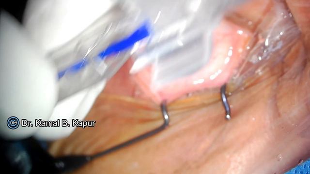 LUX SMART PRELOADED  IOL Simple Implantation Technique  - Dr Kamal B Kapur