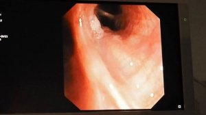 01 Соколов СА Бронхоскопия, биопсия Рак легкого OLYMPUS