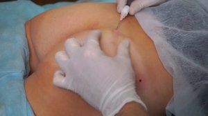 Моделирование ягодиц с применением препарата на основе полимолочной кислоты Gana X  Ярослав Лата