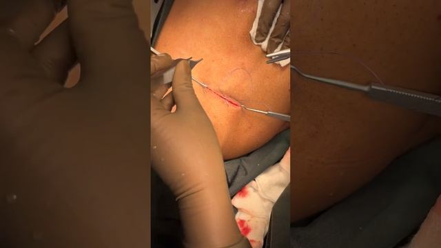 Wide local excision with Sentinel lymph node biopsy : Dr Ali Nafisa : 019 1073 4568 смотреть онлайн
