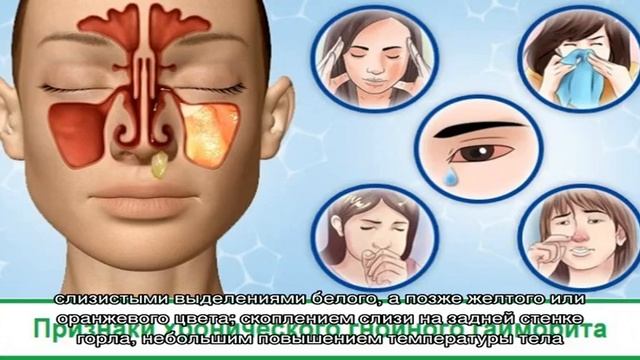 О чем говорят сопли коричневого цвета у взрослого? смотреть онлайн