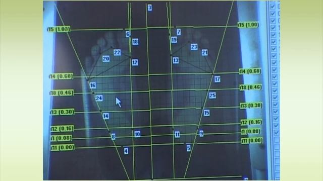 3D моделирование и изготовление ортопедических стелек смотреть онлайн