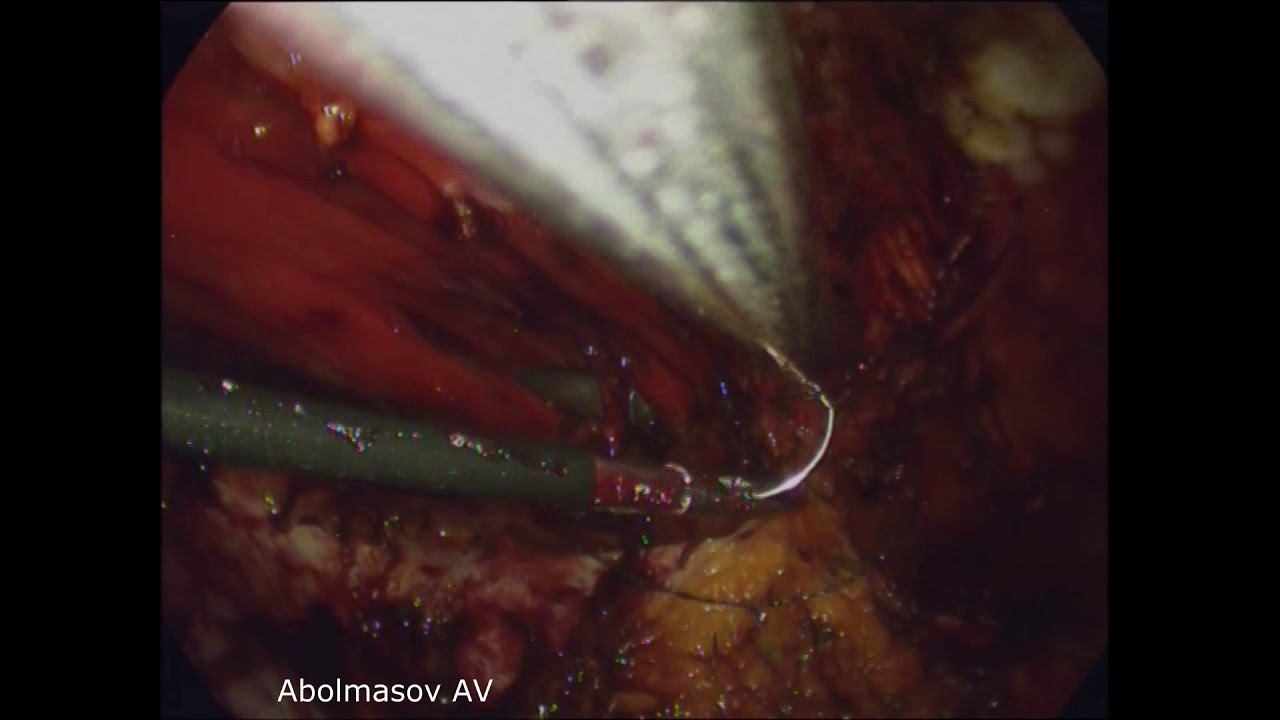 Laparoscopic ETeP RS Diastasis Recti Correction