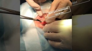 Трансконъюнктивальная блефаропластика