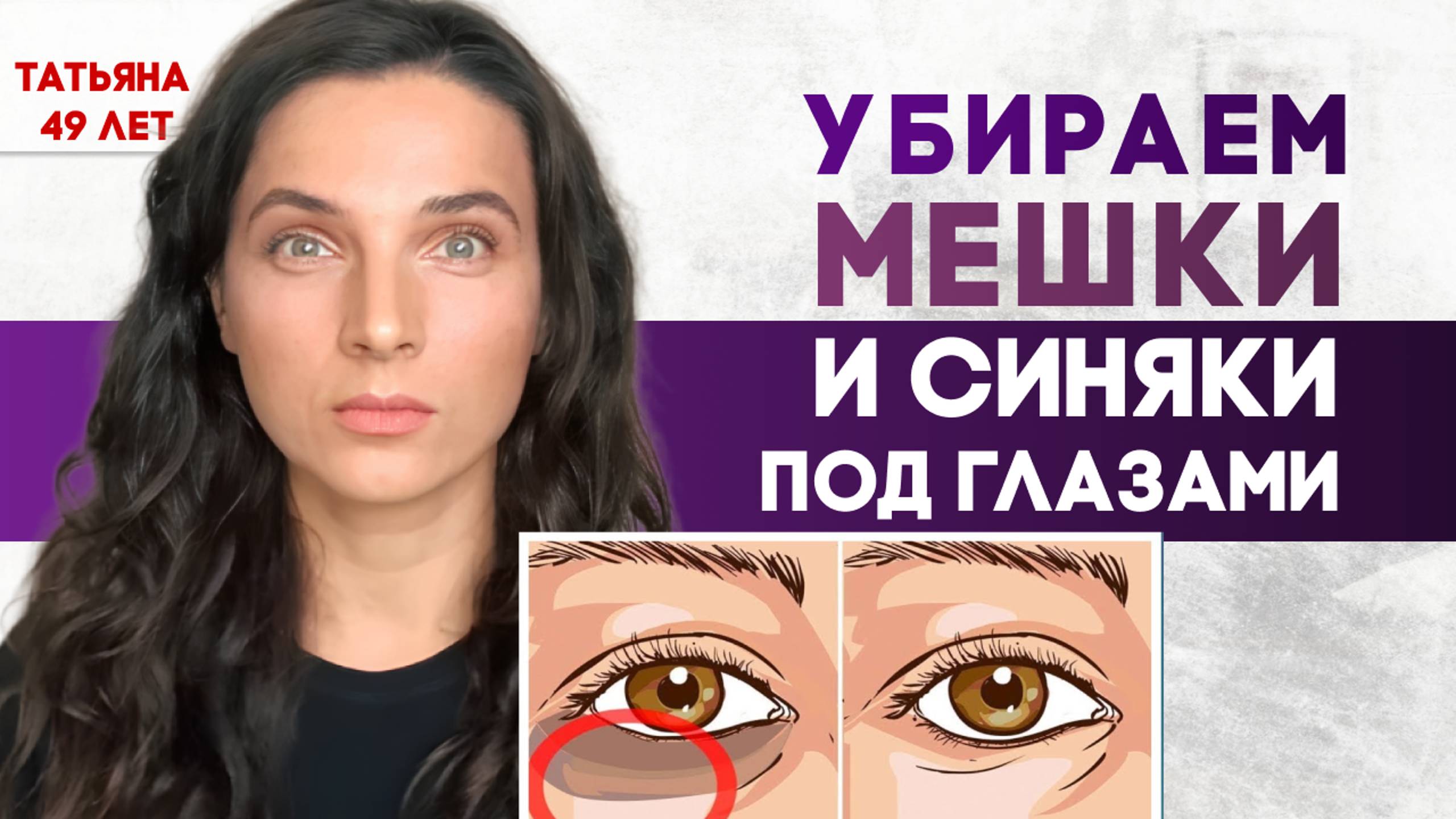 Убираем мешки и синяки под глазами смотреть онлайн