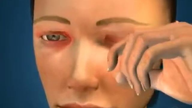 Блефарит - что это такое смотреть онлайн