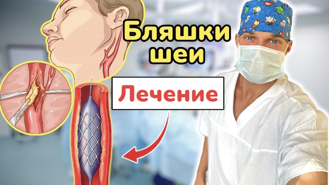 Бляшки в сосудах шеи. Атеросклероз сонных артерий. Метолы лечения. смотреть онлайн