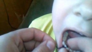 Как вырвать зуб ребенку быстро и БЕЗБОЛЕЗНЕННО