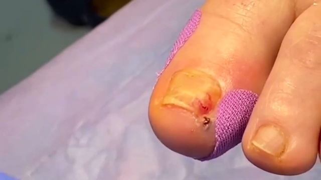 Вросший ноготь??? • Тяжёлый случай?? смотреть онлайн