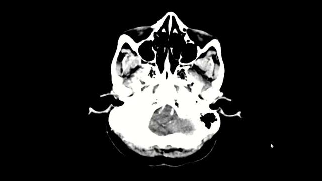 Falx meningioma: MRI brain смотреть онлайн