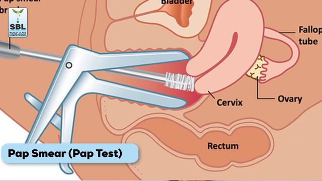 Understanding Cervical Cancer: Causes, Symptoms, Diagnosis, Treatment & Prevention