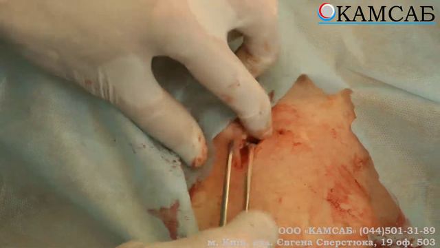 Постановка порту для хіміотерапії 2 смотреть онлайн