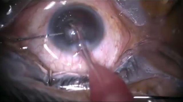 Micro Incision Cataract Surgery (MICS 2.2 mm Incision) +IOL with Dr Praveen Murthy смотреть онлайн