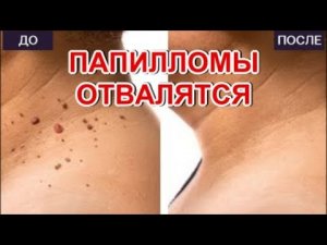 Папилломы Отвалятся!Простые методы удаления ПАПИЛЛОМ в домашних условиях.