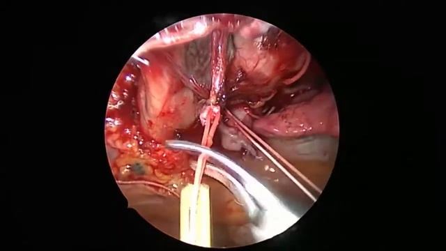 Asvide: Thoracoscopic lymph node dissection techniques for left upper lobectomy with a fused fissur смотреть онлайн
