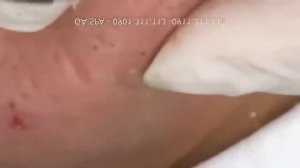 НОВОЕ ВИДЕО 2021  Акне  Прыщи давить залипательные