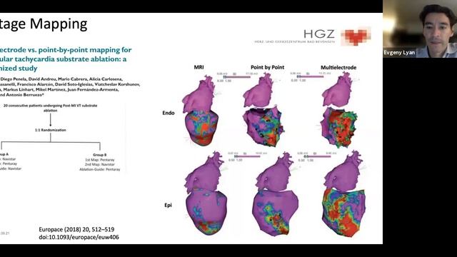 Роль мультиэлектродного картирования в катетерной аблации желудочковых тахикардий. Евгений Лян смотреть онлайн